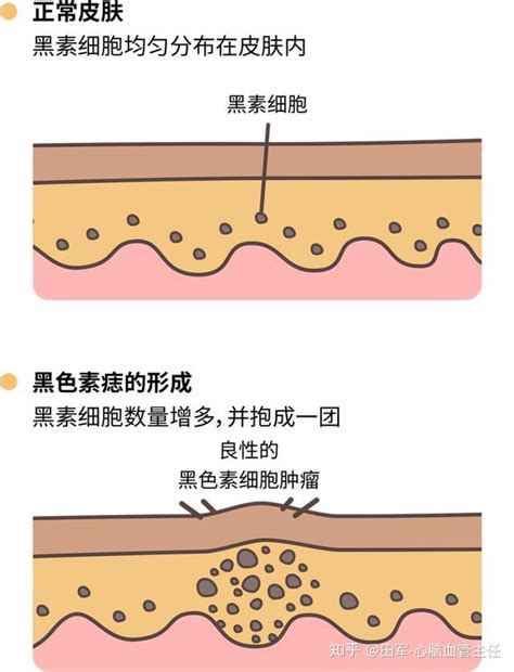 虎口突然長痣|痣也可能会癌变！长在 3 个地方要注意